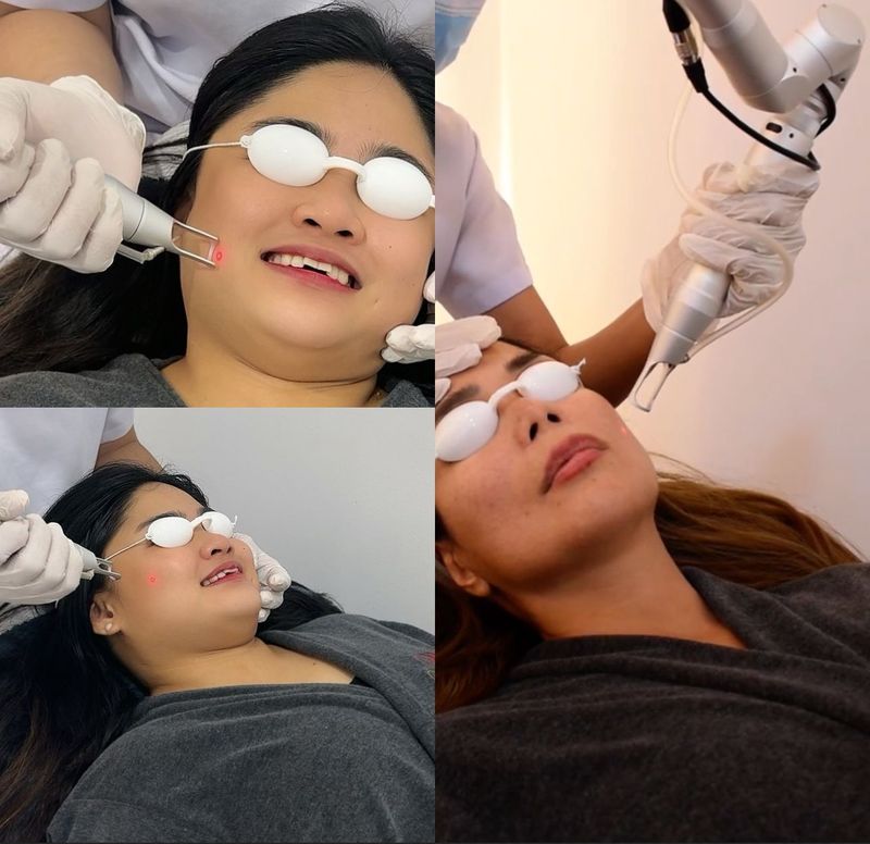 Pico Laser Precision Treatment Pico Laser